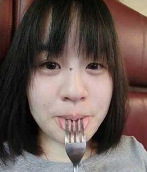 激光去雀斑把我遺傳性的雀斑給全部去掉啦