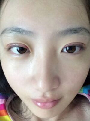 何賢清全切雙眼皮加去脂肪 果賊自然