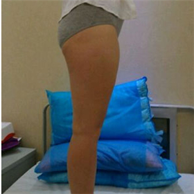 東方和諧馮斌做的大腿吸脂，給你們看看前后對比果圖片！