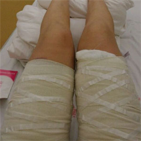 東方和諧馮斌做的大腿吸脂，給你們看看前后對比果圖片！