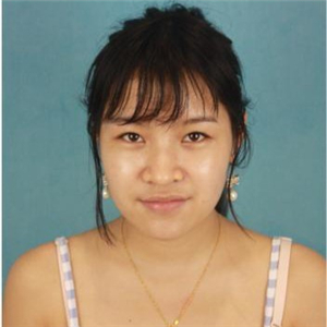 在米揚(yáng)麗格做的自體軟骨隆鼻，巫文云院長(zhǎng)的技術(shù)棒棒噠！