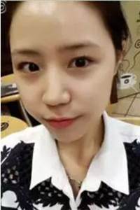 找夏正義做自體脂肪面部填充三個月了，恢復(fù)果很好有對比照片哦~~