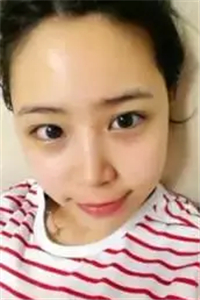 找夏正義做自體脂肪面部填充三個月了，恢復(fù)果很好有對比照片哦~~