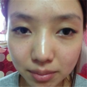 米揚(yáng)麗格夏正義做雙眼皮果怎么樣？看看我的前后對比果圖片吧！