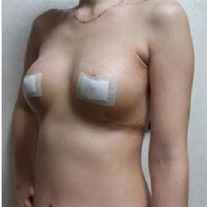 南昌同濟(jì)做的極速動(dòng)感微創(chuàng)豐胸術(shù)，分享下我的恢復(fù)過(guò)程圖片吧~