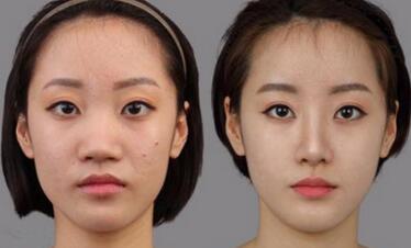 隆鼻+鼻翼縮小前后對比圖