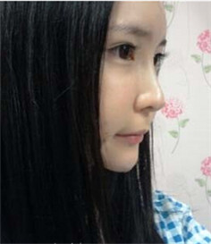 大家都來評價一下劉琦做的玻尿酸隆鼻果 還不錯吧