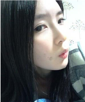 大家都來評價一下劉琦做的玻尿酸隆鼻果 還不錯吧