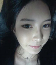 大家都來評價一下劉琦做的玻尿酸隆鼻果 還不錯吧