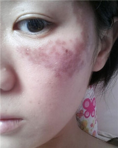 華美杜姜做的激光祛斑 果好不好你來(lái)看