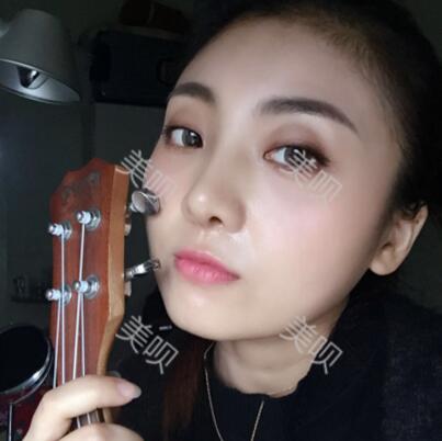 我的玻尿酸隆鼻后大家來看看果怎么樣