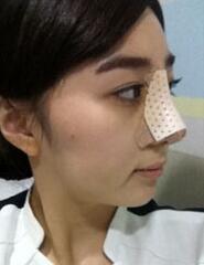 深圳希思崔院長隆鼻整形 擺脫了豬妹妹的稱號