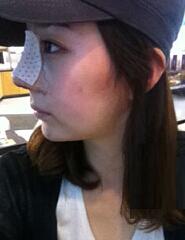 深圳希思崔院長隆鼻整形 擺脫了豬妹妹的稱號