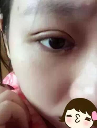 深圳希思做的雙眼皮+開眼角 感謝楊醫(yī)師！