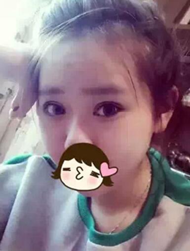 深圳希思做的雙眼皮+開眼角 感謝楊醫(yī)師！