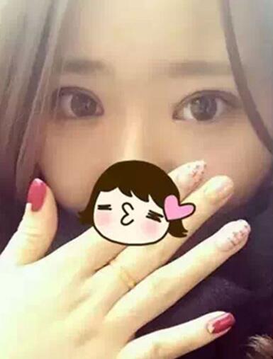 深圳希思做的雙眼皮+開眼角 感謝楊醫(yī)師！