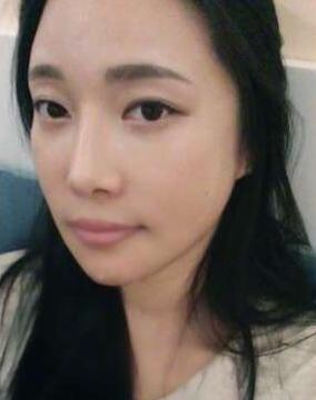 柳大烈給我做的改臉型手術(shù) 求圍觀！