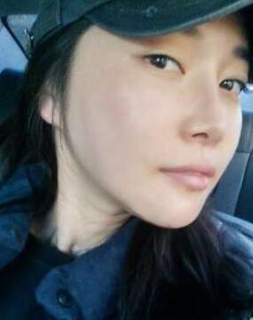 柳大烈給我做的改臉型手術(shù) 求圍觀！