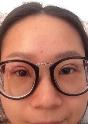全切雙眼皮改良了我的內(nèi)雙腫泡眼，多虧了何賢清醫(yī)生