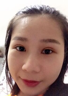 全切雙眼皮改良了我的內(nèi)雙腫泡眼，多虧了何賢清醫(yī)生