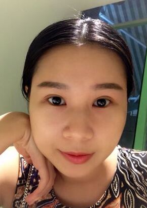 全切雙眼皮改良了我的內(nèi)雙腫泡眼，多虧了何賢清醫(yī)生