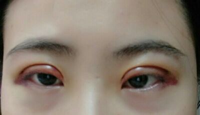 全切雙眼皮后眼形漂亮多了，安徽維多利亞徐和林做的喲