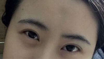 全切雙眼皮后眼形漂亮多了，安徽維多利亞徐和林做的喲