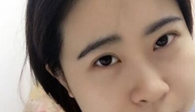 全切雙眼皮后眼形漂亮多了，安徽維多利亞徐和林做的喲