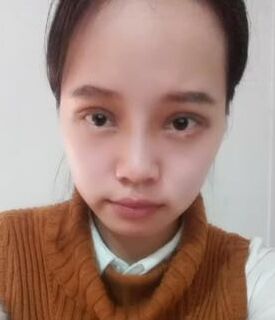 全切雙眼皮+去脂肪，終于擺脫小眼睛了