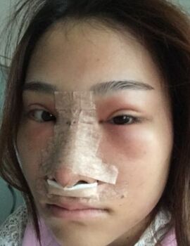 硅膠隆鼻還墊鼻尖了，甘泉涌做的果真的很好喲