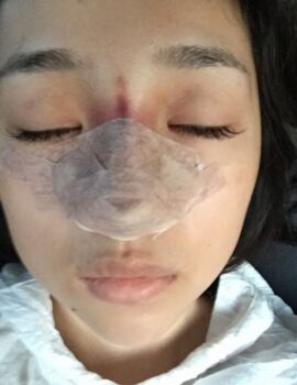 合肥楊鵬隆鼻整形真實案例分享