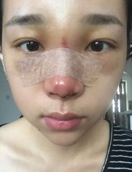 合肥楊鵬隆鼻整形真實案例分享