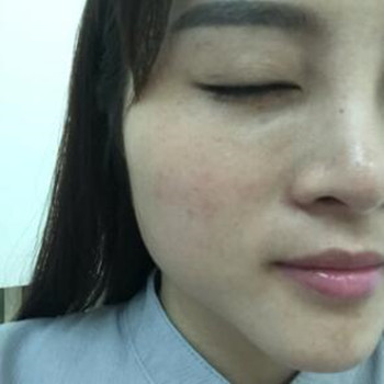 做了高強度聚焦超聲除皺小細(xì)紋都沒有啦 大家快來圍觀啊