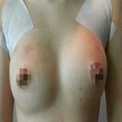 自體脂肪隆胸真的變大胸了 感謝成都天使之翼