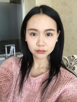 成都天使之翼做隆鼻整形改變了我的塌鼻子 果真的很不錯(cuò)