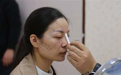 做了隆鼻整形從丑小鴨蛻變?yōu)榘滋禊Z 成都天使之翼做的哦