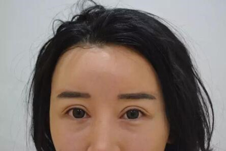 成都天使之翼做的雙眼皮修復(fù)怎么樣 快來(lái)圍觀
