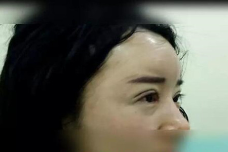 成都天使之翼做的雙眼皮修復(fù)怎么樣 快來(lái)圍觀