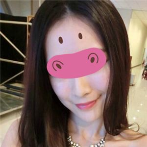 黃慶武醫(yī)生做的音波拉皮除皺手術分享，有很多前后對比果圖片哦~~~