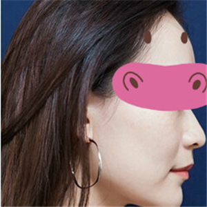 黃慶武醫(yī)生做的音波拉皮除皺手術分享，有很多前后對比果圖片哦~~~