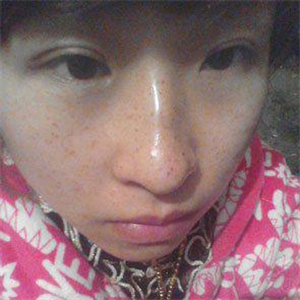 去格萊美做了激光去雀斑，有恢復(fù)前后的對(duì)比照片哦，還不錯(cuò)~~