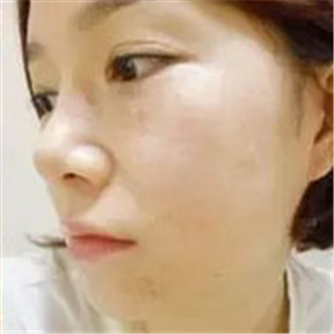 做了激光去雀斑前后對(duì)比照片分享，黃俊俊的技術(shù)很好哦！