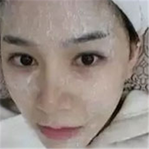 做了激光去雀斑前后對(duì)比照片分享，黃俊俊的技術(shù)很好哦！