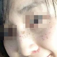 花費4000元做了激光祛斑，終于把雀斑消滅了555555