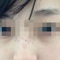 花費4000元做了激光祛斑，終于把雀斑消滅了555555