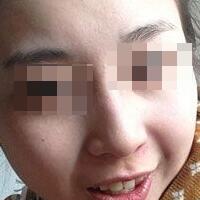 花費4000元做了激光祛斑，終于把雀斑消滅了555555