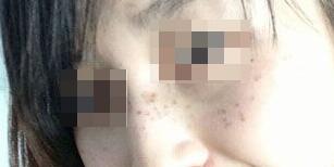 激光祛斑費(fèi)用4000元