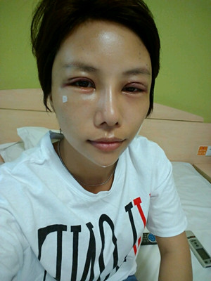 美萊鄧正輝做的切開(kāi)雙眼皮 終于變美了