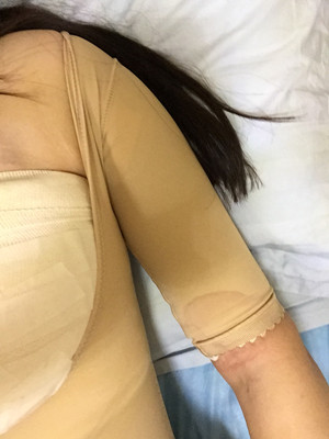 手臂吸脂后變軟妹紙 美萊鄧正輝做的