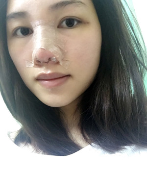 多虧了付俊俐醫(yī)生做的隆鼻整形 臉變立體了